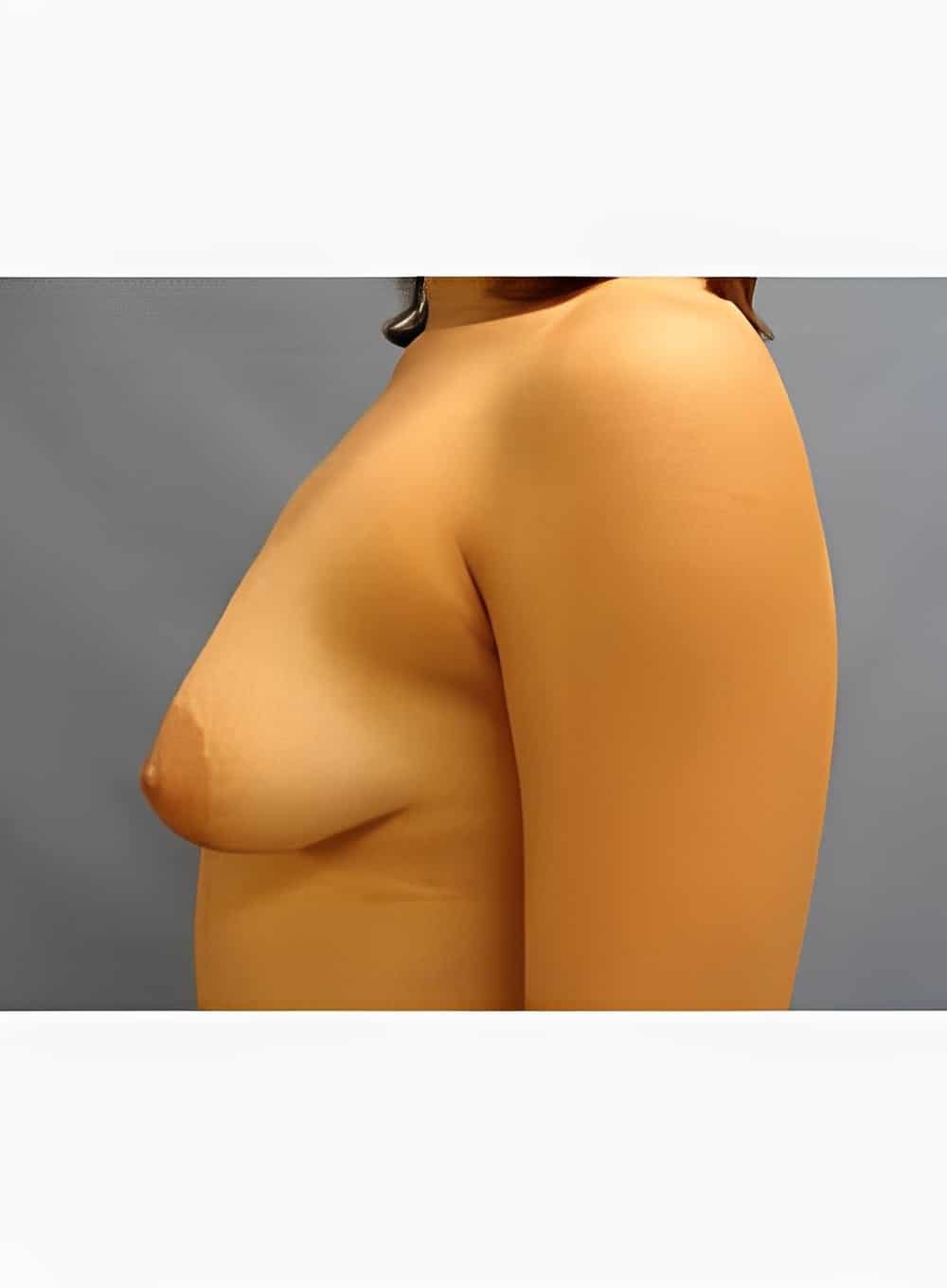 Before Image: Breast Augmentation-Dr. Kenrick Spence - left-side