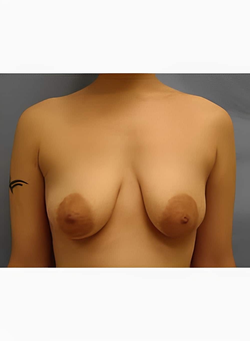 Before Image: Breast Augmentation-Dr. Kenrick Spence - front