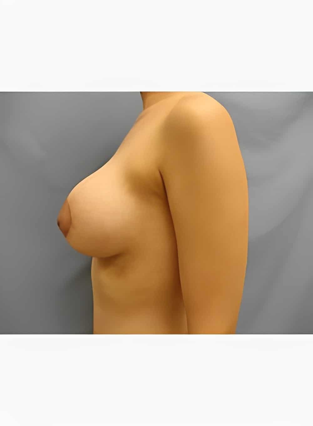 After Image: Breast Augmentation-Dr. Kenrick Spence - left-side