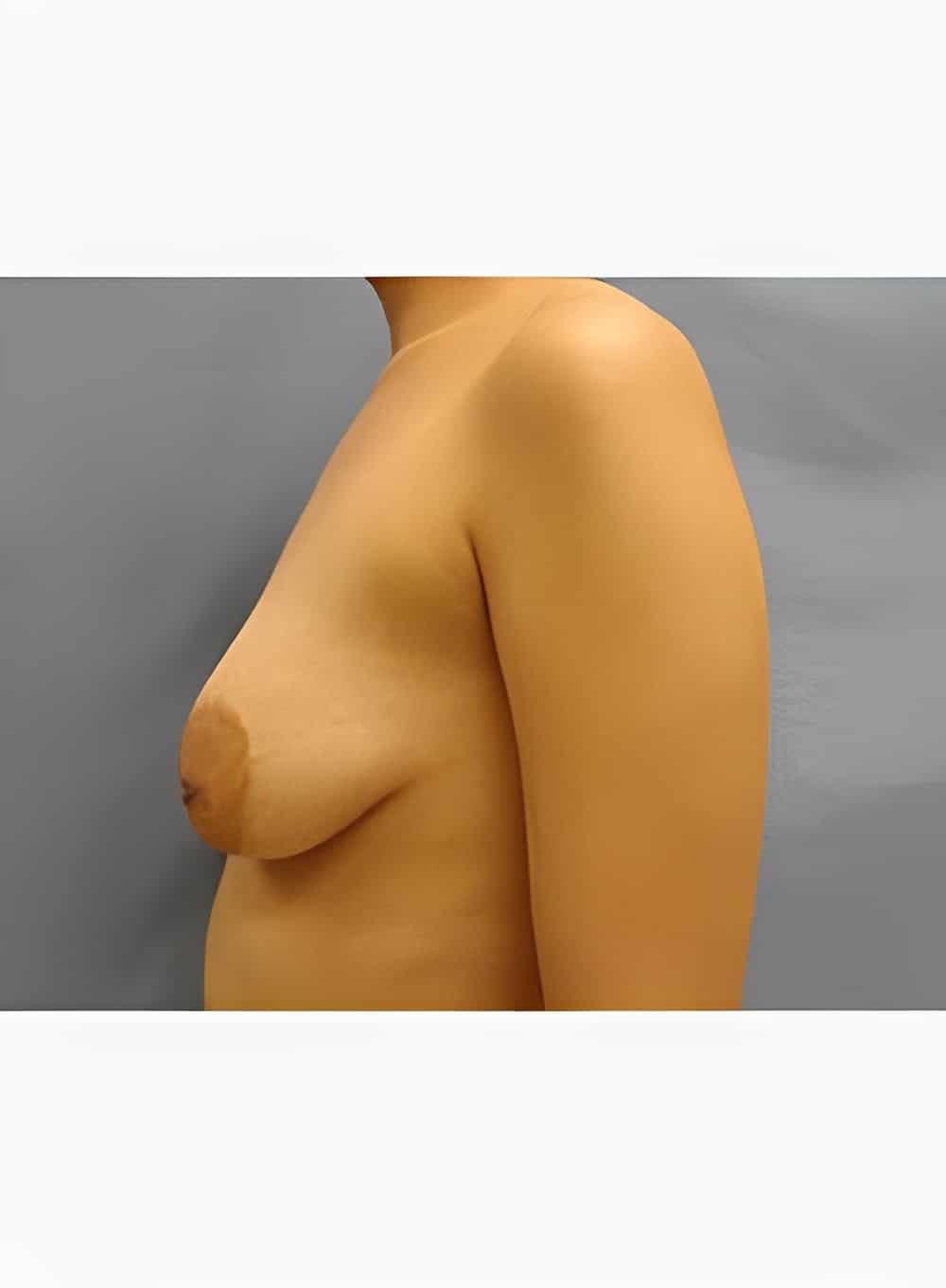 Before Image: Breast Augmentation-Dr. Kenrick Spence - left-side