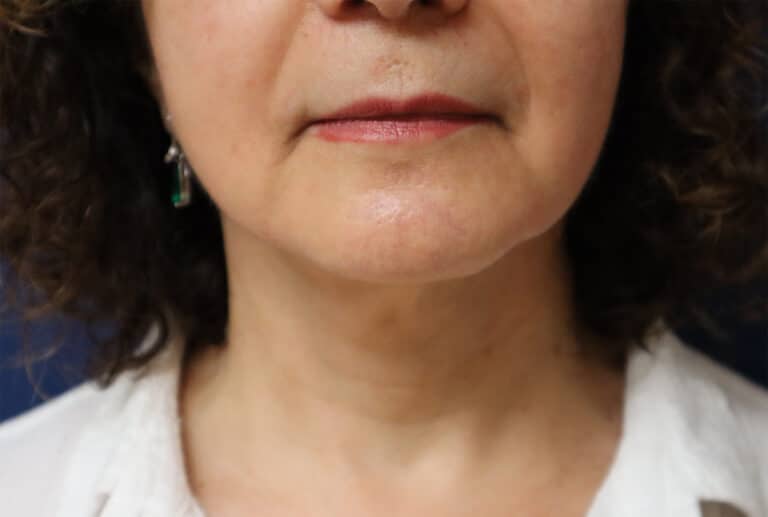 After Image: Necklift-Dr. Kenrick Spence - front