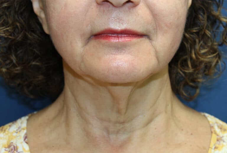Before Image: Necklift-Dr. Kenrick Spence - front