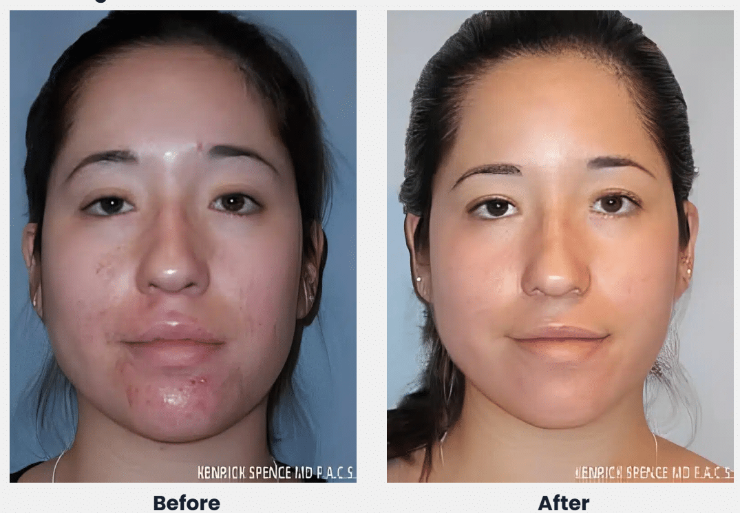 Before and after photos of a woman's face, front view, for chemical peels