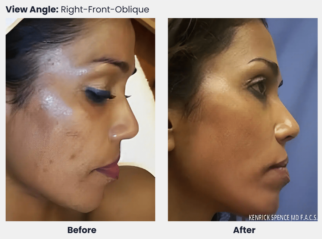 Before and after photos of a woman's face from the side, for chemical peels