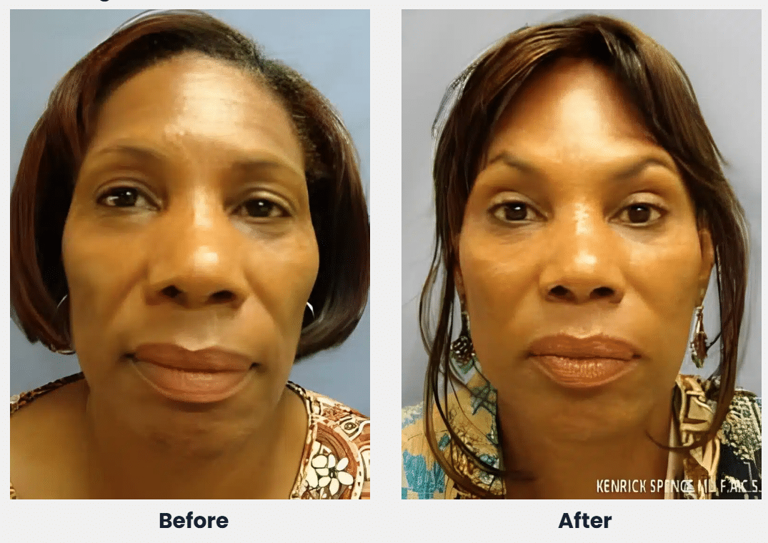 Before and after photos of a woman's face, front view, for chemical peels