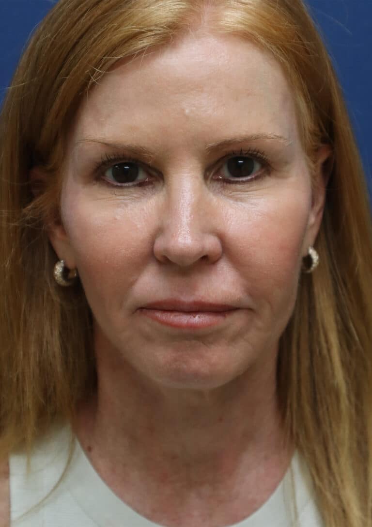 After Image: Facelift and Fat Grafting-Dr. Kenrick Spence - front