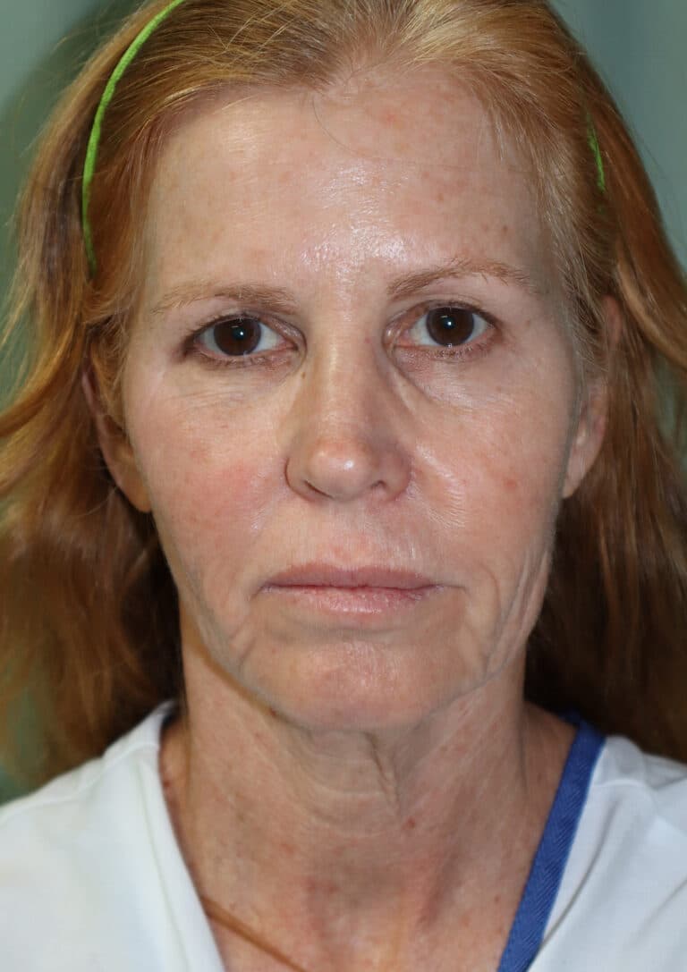 Before Image: Facelift and Fat Grafting-Dr. Kenrick Spence - front