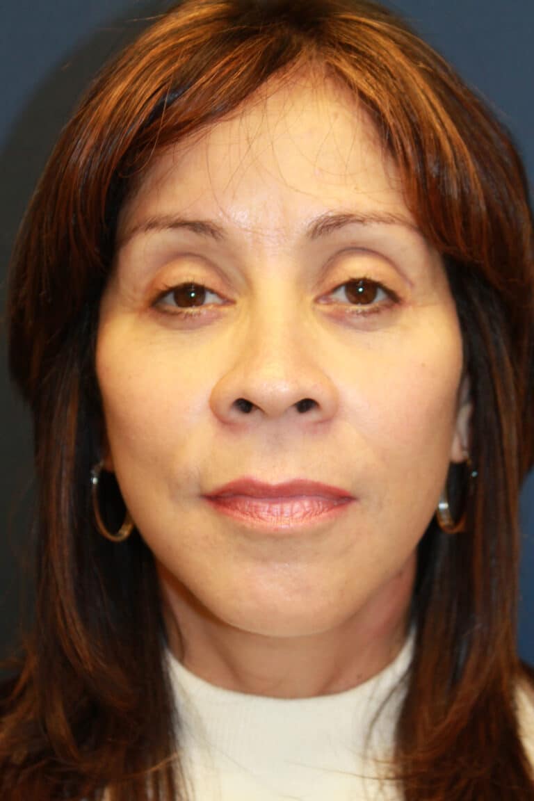 After Image: Lower Facelift-Dr. Kenrick Spence - front