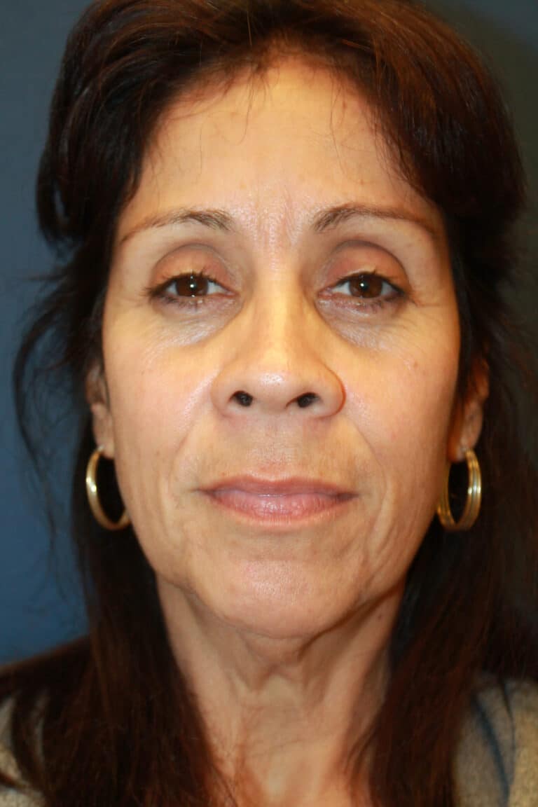 Before Image: Lower Facelift-Dr. Kenrick Spence - front