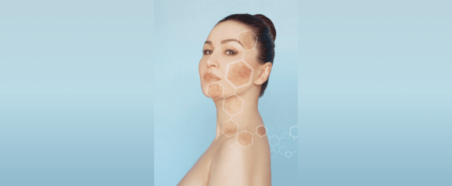 woman with melasma concerns