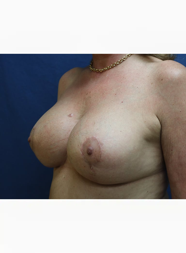 After Image: Breast Augmentation and Lollipop Mastopexy-Dr. Kenrick Spence - left-front-oblique