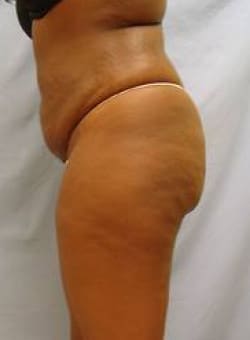 Before Image: Liposuction Back-Dr. Kenrick Spence - left-side