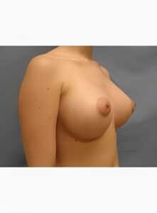 After Image: Breast Augmentation-Dr. Kenrick Spence