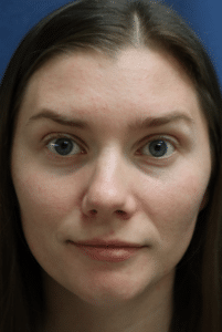 After Image: Botox-Isis Bucci APRN