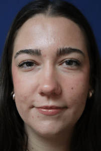 Before Image: Lip Filler-Isis Bucci APRN