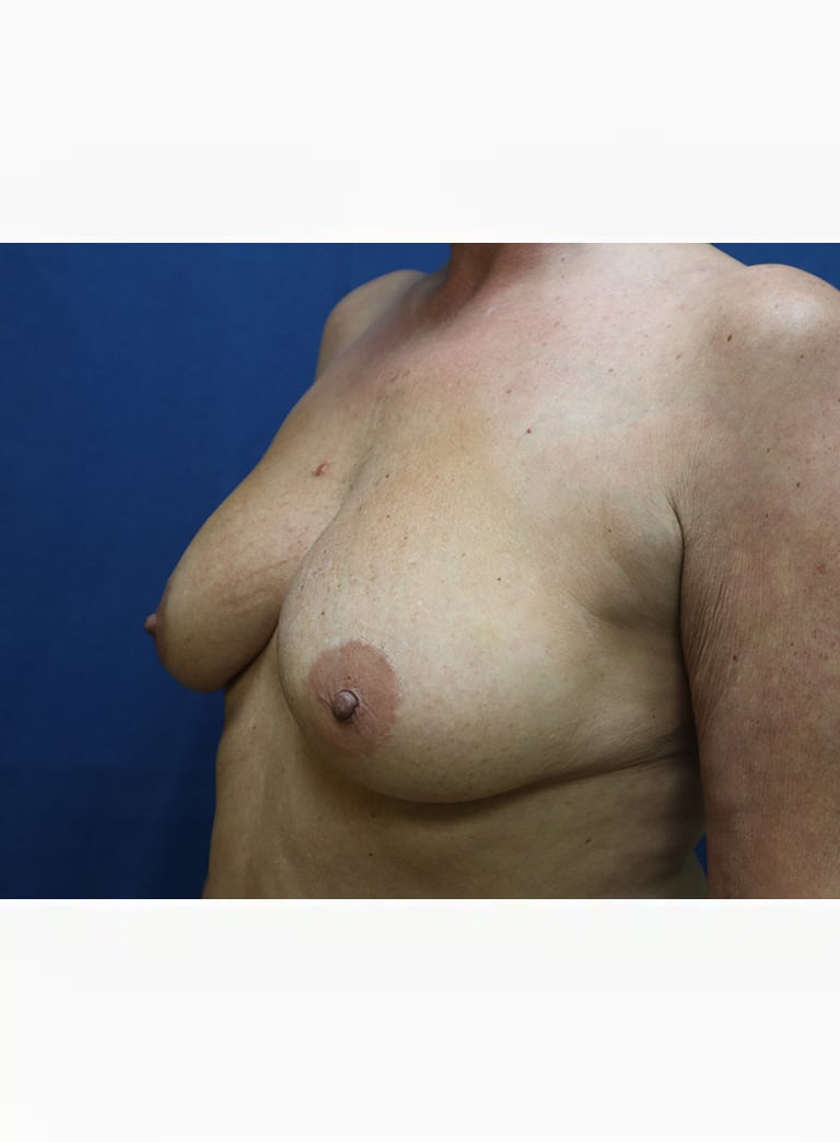 Before Image: Breast Augmentation and Lollipop Mastopexy-Dr. Kenrick Spence - left-front-oblique
