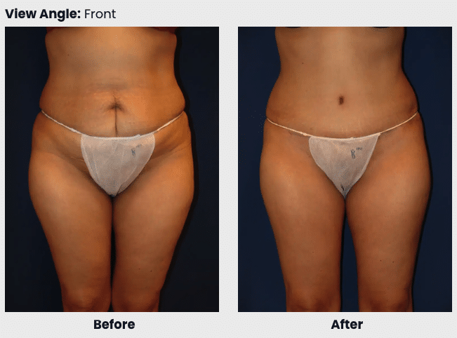 abdominoplasty before after 1