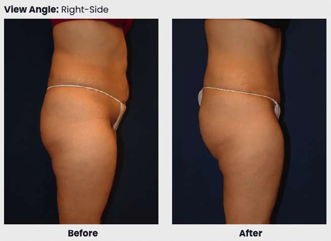 abdominoplasty before after 3