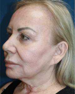 Before Image: Brow Lift & Eyelid Surgery and Lower Facelift– Dr. Kenrick Spence
