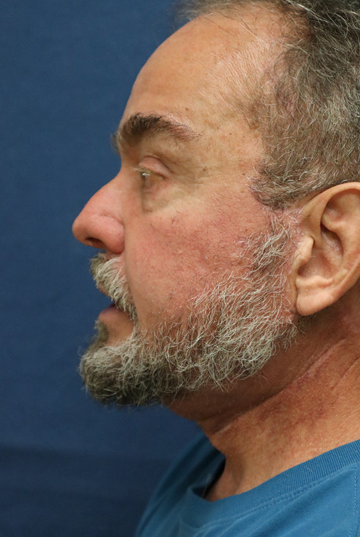 After Image: Lower Facelift, Neck Lift, Brow Lift, Eyelid Surgery & Fat Grafting-Dr. Kenrick Spence - left-side