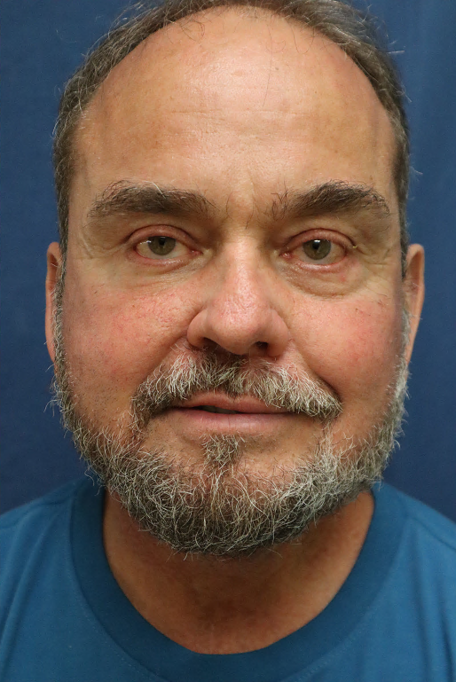 After Image: Lower Facelift, Neck Lift, Brow Lift, Eyelid Surgery & Fat Grafting-Dr. Kenrick Spence - front