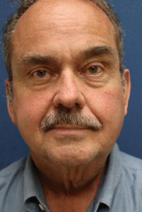 Before Image: Lower Facelift, Neck Lift, Brow Lift, Eyelid Surgery & Fat Grafting-Dr. Kenrick Spence