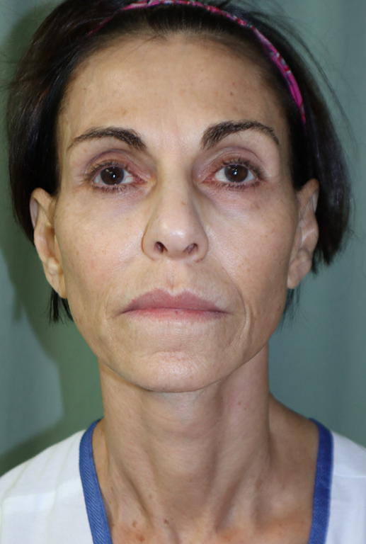 Before Image: Brow Lift, Facelift, Fat Grafting and Lip Lift-Dr. Kenrick Spence - front