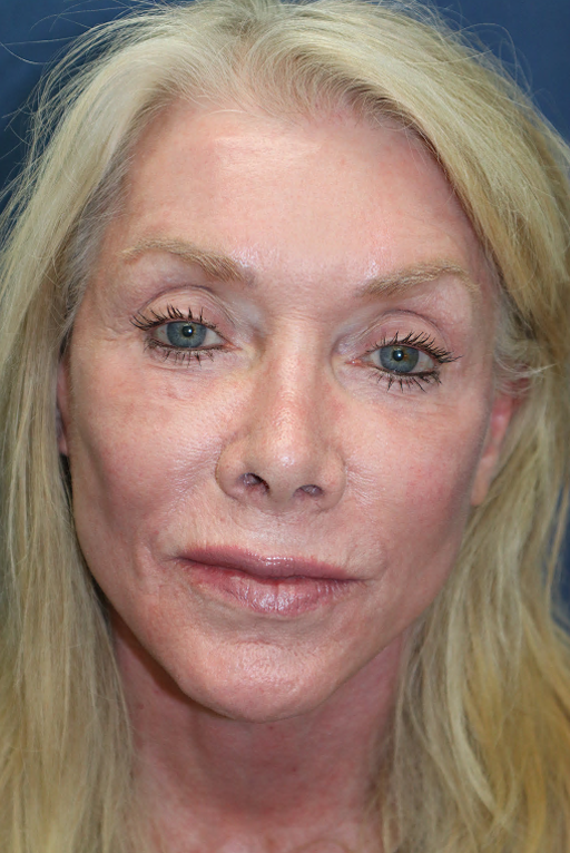 After Image: Neck Lift, Facelift, Brow Lift, Fat Grafting, and Microneedling-Dr. Kenrick Spence - front