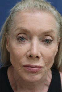 Before Image: Neck Lift, Facelift, Brow Lift, Fat Grafting, and Microneedling-Dr. Kenrick Spence