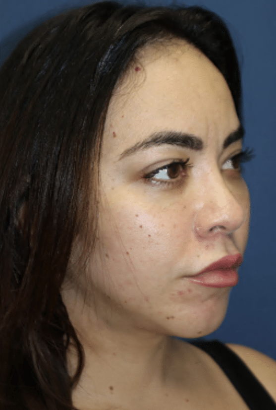 After Image: Facelift, Neck Lift, Neck Liposuction, and Lip Lift-Dr. Kenrick Spence - right-front-oblique