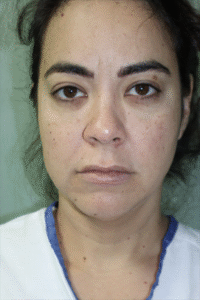 Before Image: Facelift, Neck Lift, Neck Liposuction, and Lip Lift-Dr. Kenrick Spence