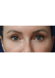 After Image: Brow lift and Blepharoplasty – Dr. Kenrik Spence
