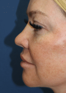 After Image: Brow lift, Blepharoplasty, and Lower Facelift – Dr. Kenrick Spence