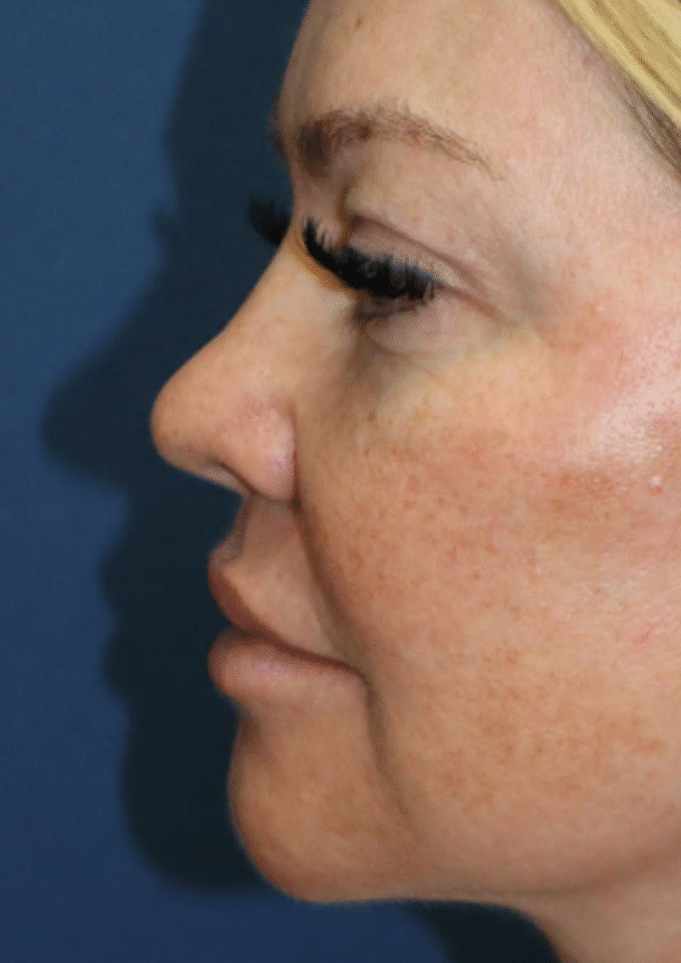 After Image: Brow lift, Blepharoplasty, and Lower Facelift – Dr. Kenrick Spence - left-side