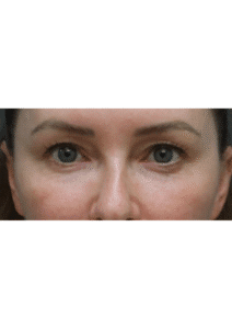 Before Image: Brow lift and Blepharoplasty – Dr. Kenrik Spence