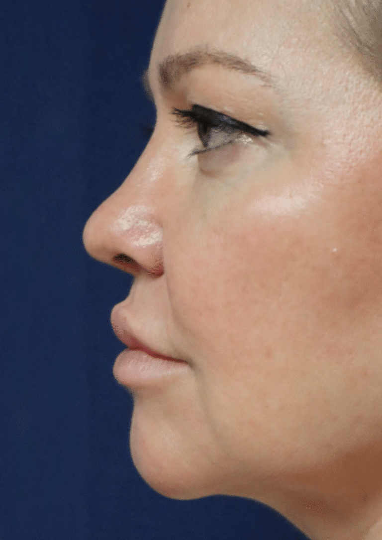 Before Image: Brow lift, Blepharoplasty, and Lower Facelift – Dr. Kenrick Spence - left-side