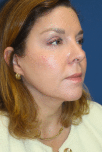 Sculptra After Image of a Woman