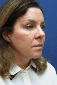 Sculptra Before Image of a Woman